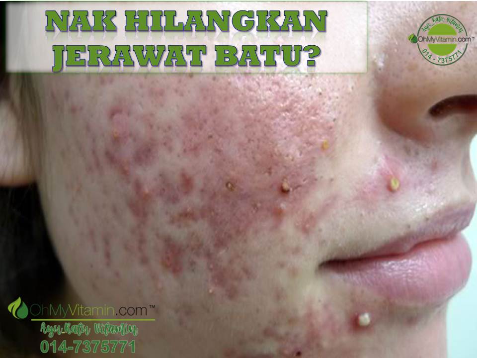 HILANG JERAWAT BATU