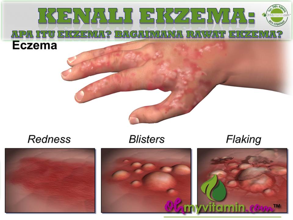 KENALI APA ITU EKZEMA DAN BAGAIMANA RAWAT EKZEMA